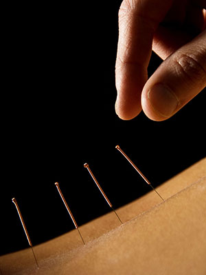 acupuncture needles acupuncture benefits